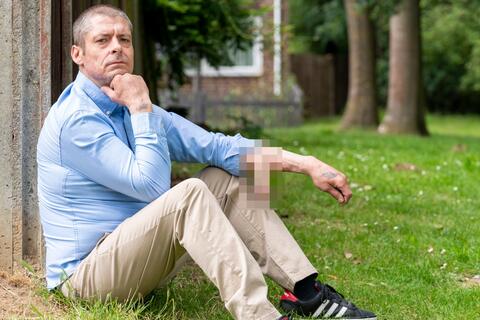 Người đàn ông có dương vật trên cánh tay suốt 6 năm