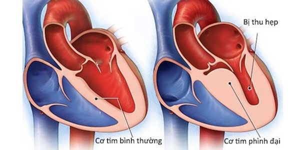 Bộ Y tế bác tin virus lạ viêm cơ tim gây chết nhiều người