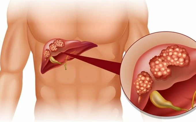 Đồ ăn nhanh có chứa nhiều muối natri gây ra các tình trạng rối loạn chức năng thận.