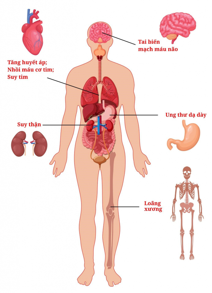 Ăn thừa muối: Yếu tố tăng gánh nặng bệnh tật trên toàn cầu