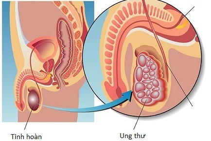 Siêu âm bìu: phát hiện được 75% khối u, xác định có hay không tràn dịch màng tinh hoàn.