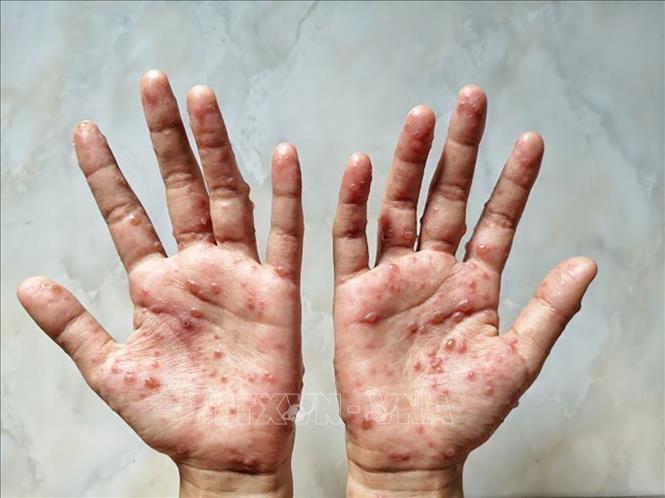 Brazil sử dụng thuốc kháng virus Tecovirimat điều trị bệnh nhân mắc đậu mùa khỉ nặng - Ảnh 1.