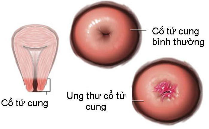 Bệnh ung thư cổ tử cung có thể điều trị nếu phát hiện sớm. 