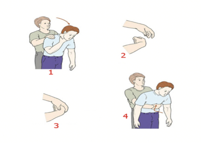 Chi tiết thủ thuật Heimlich