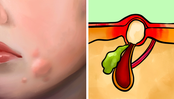 Các nguyên nhân nào có thể gây ra mụn trứng cá