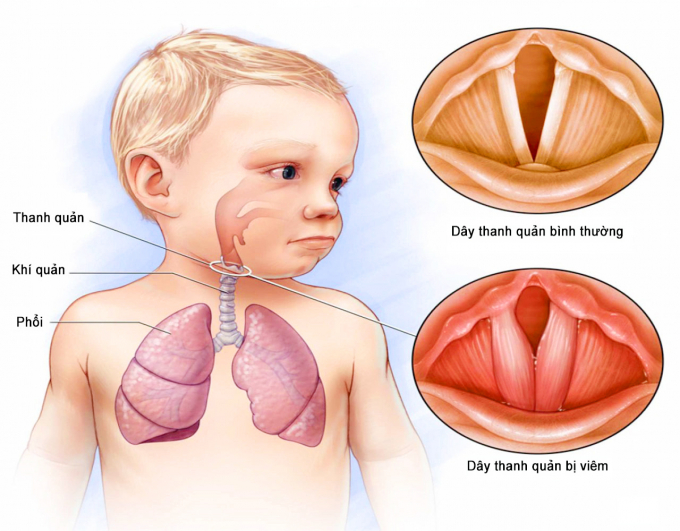 Bạch hầu thanh quản tiến triển nhanh và rất nguy hiểm, bệnh có dấu hiệu dấu hiệu sốt, khàn giọng, ho ông ổng.