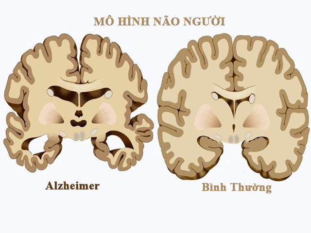 Đã tìm thấy thuốc làm chậm sự tiến triển của bệnh Alzheimer. - Ảnh 1.