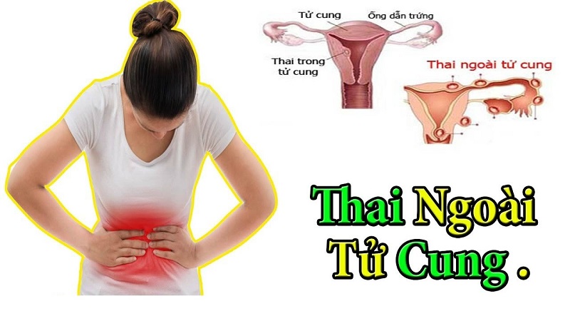 Dấu hiệu sớm nhận biết mang thai ngoài tử cung