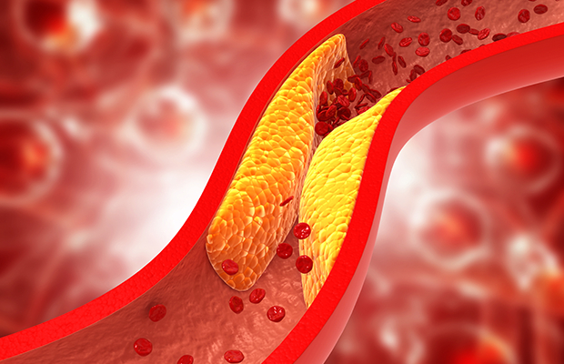  Tiến sĩ Saya Nagori cảnh báo cholesterol cao có thể là một “quả bom hẹn giờ” đối với sức khỏe.