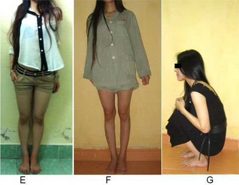 Kết quả sau khi xương liền chắc, đinh được rút bỏ, bệnh nhân đi đứng và ngồi bình thường.