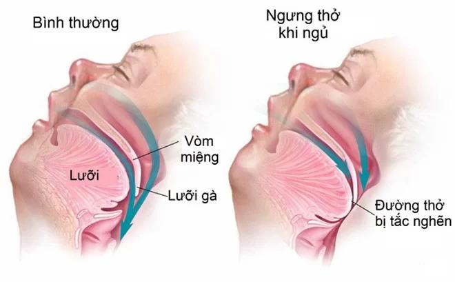 Một người mắc bệnh ngủ ngáy sẽ có nguy cơ ngưng thở khi ngủ cao hơn.