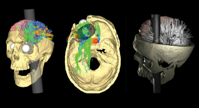 Hình ảnh tái hiện trường hợp Phineas Gage gần đây nhất (2012)