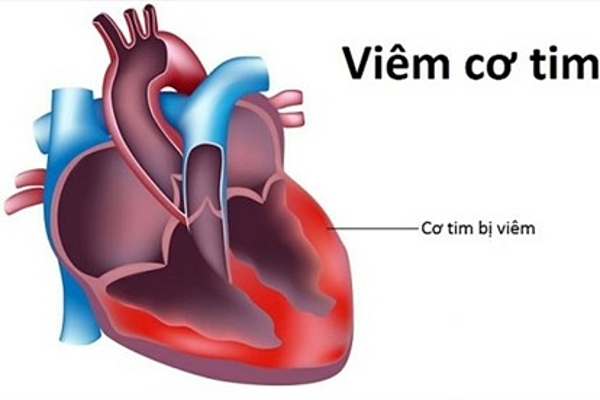 Thực hư virus viêm cơ tim gây chết người đang xôn xao cộng đồng mạng