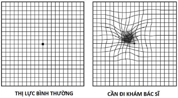 Bài kiểm tra của Amsler giúp xác định sớm căn bệnh thoái hóa điểm vàng.