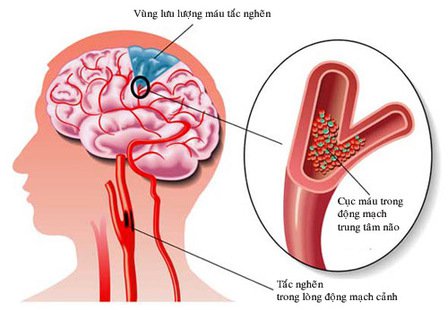 Dấu hiệu nhận biết đột quỵ. 