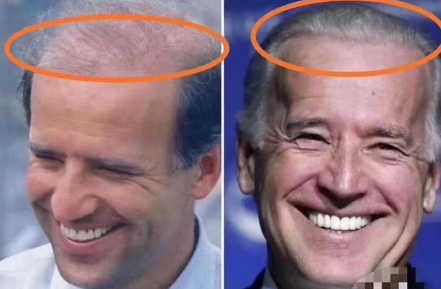   Ông Joe Biden được cho là đã cấy tóc để sở hữu mái tóc dày dặn, bóng mượt hơn.  