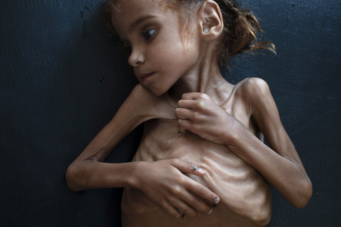 Amal Hussain, 7 tuổi bị suy dinh dưỡng, nằm trên giường tại một phòng khám UNICEF di động ở Aslam, Yemen, vào tháng 10 năm 2018. Cô qua đời vài ngày sau khi tờ New York Times đăng một câu chuyện về cô và cuộc khủng hoảng nạn đói ở Yemen . Ảnh: Tyler Hicks / Thời báo New York / Redux