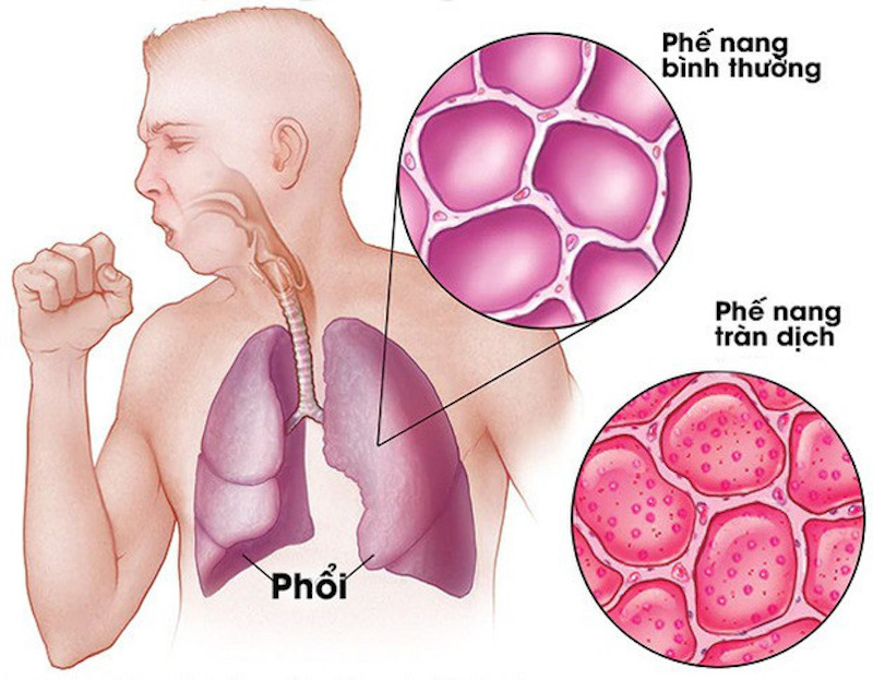 Virus COVID-19 tàn phá lá phổi bằng cách nào?