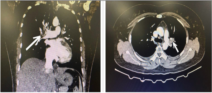   Hình ảnh CT lồng ngực bệnh nhân bị tắc động mạch phổi cấp tính  